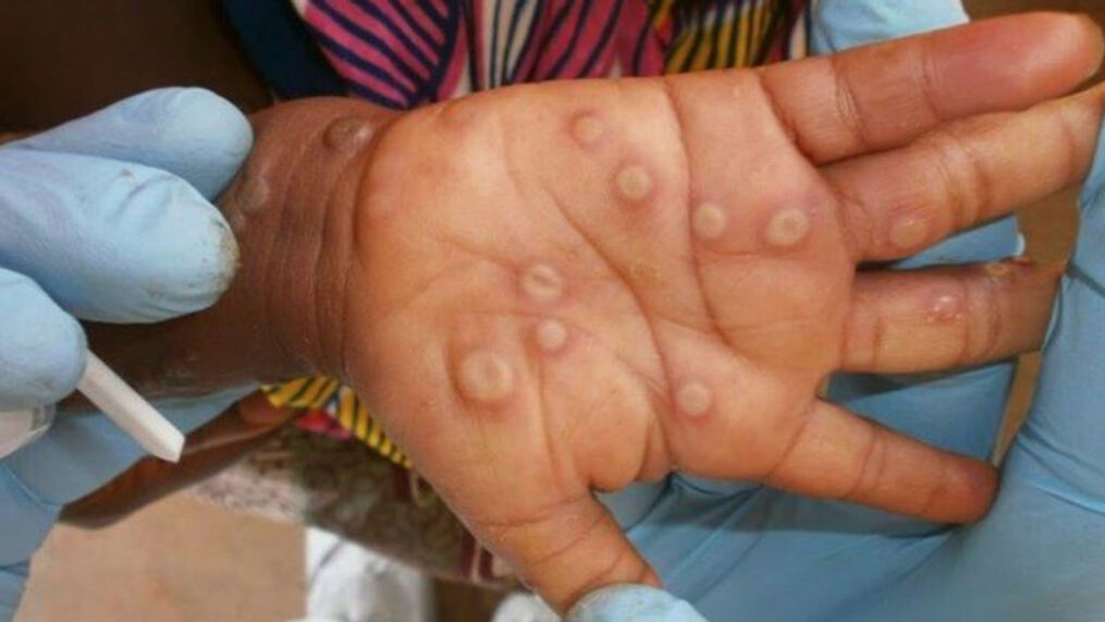 (MONKEY POX) मंकी पॉक्‍स से बचने के लिए सावधानी जरूरी